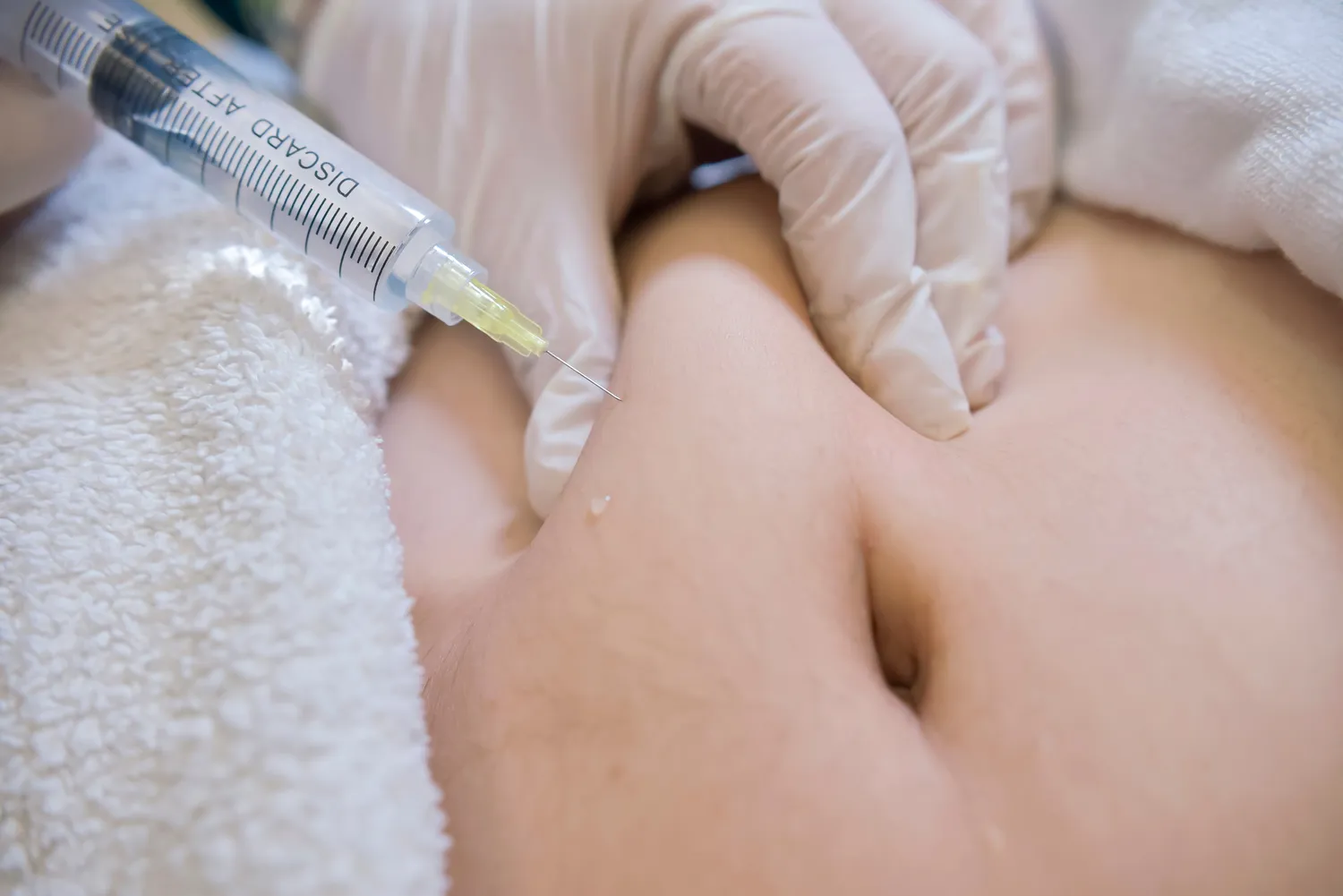 Privatpraxis Dr. Kusian - ästhetischen Medizin - Nahaufnahme einer Lipotropinjektion in das Unterhautfettgewebe unterhalb des Nabels. Lokales Verfahren zur Reduzierung von Fett und Cellulite.